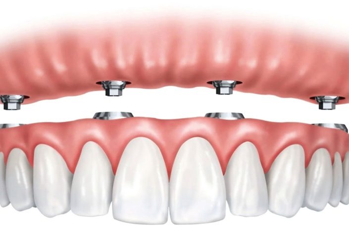 دندان مصنوعی با ایمپلنت؛ ترکیبی از ثبات و زیبایی برای لبخندی طبیعی