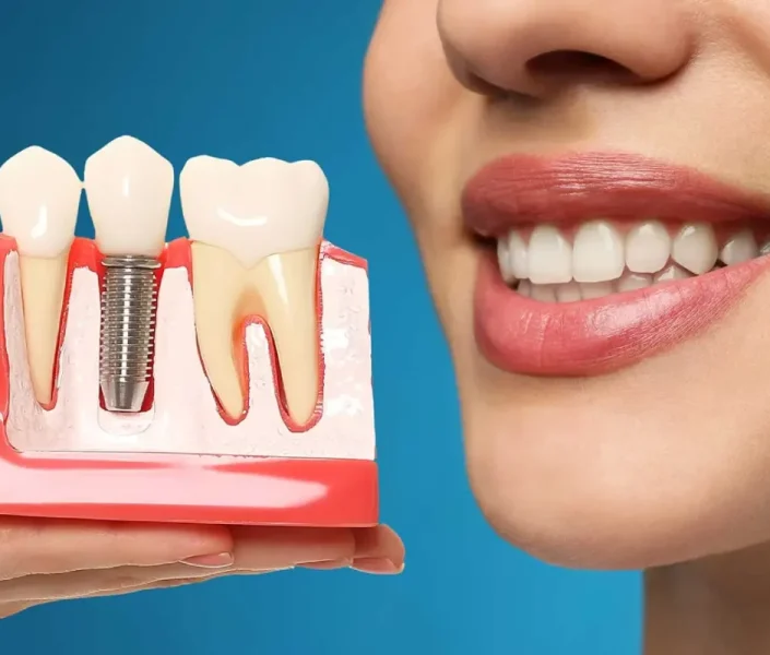 ایمپلنت‌های دندانی برای سلامت دهان و دندان؛ از زیبایی تا پیشگیری از مشکلات جدی