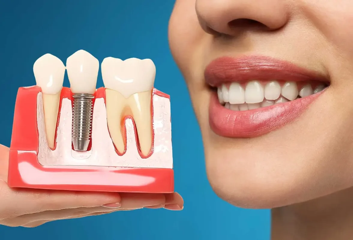 ایمپلنت‌های دندانی برای سلامت دهان و دندان؛ از زیبایی تا پیشگیری از مشکلات جدی